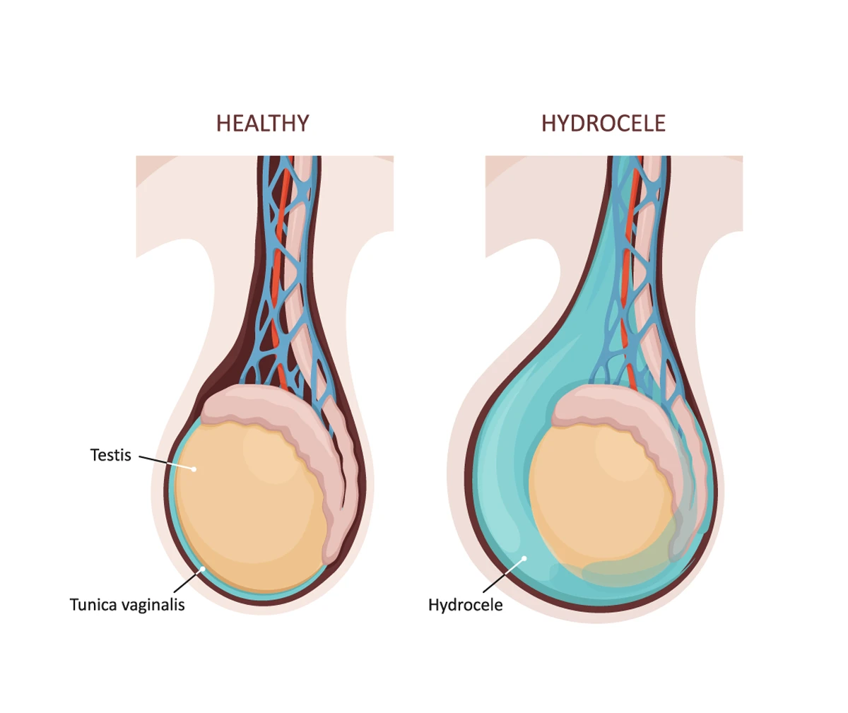 premature-ejaculation-treatment-in-noida