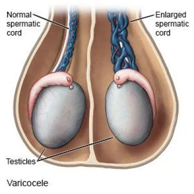 premature-ejaculation-treatment-in-noida